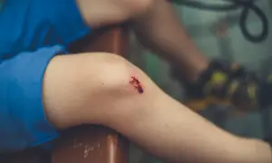 Dziecko z otartym kolanem, które może być jednym z objawów tężyczki.
