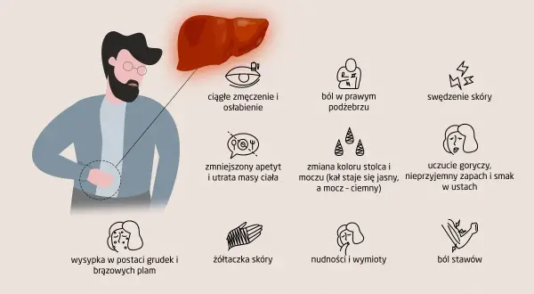 Ilustracja przedstawia objawy chorób wątroby, m.in. zmęczenie, ból w prawym podżebrzu, swędzenie skóry, nudności i wymioty. Wzw C może objawiać się podobnie.