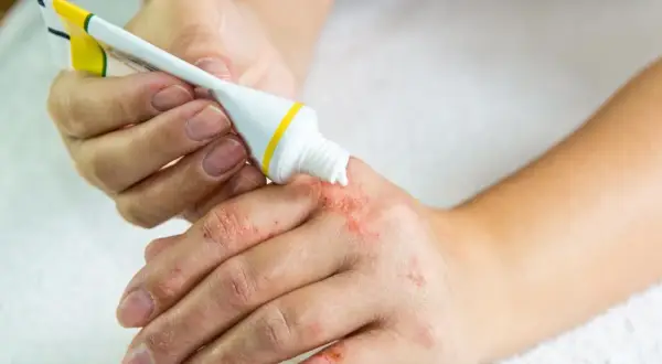 Osoba aplikuje dermovate maść na suchą, zaczerwienioną skórę dłoni.