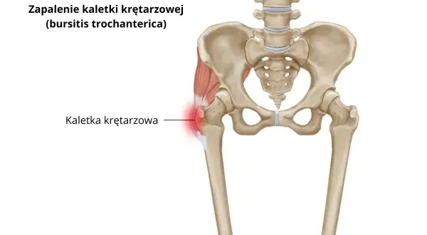Leczenie zapalenia kaletki krętarzowej: Skuteczne leki i terapie