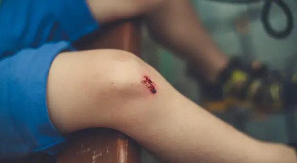 Dziecko z otartym kolanem, które może być jednym z objawów tężyczki.