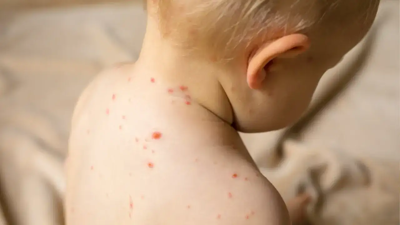 Czerwone plamki na skórze dziecka, widoczne na karku i ramionach, mogą być objawami odry.